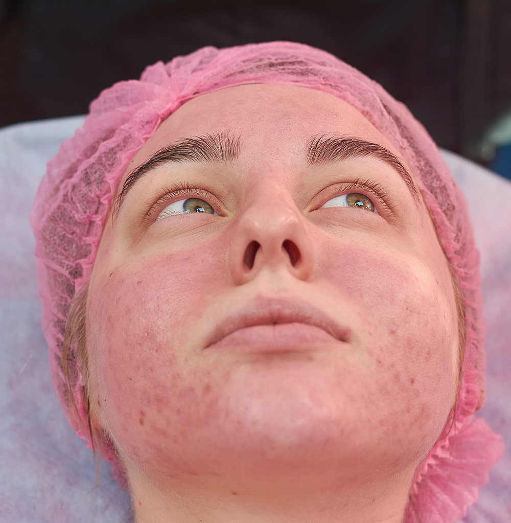 Banner_servicios_rosácea